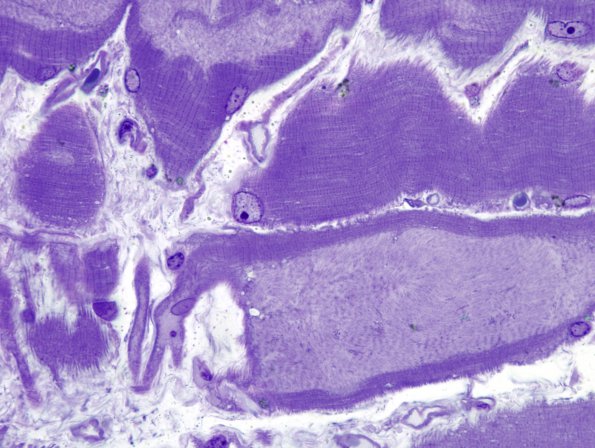 1D2 Myosin Loss Myopathy, patchy (Case 1) Plastic 4