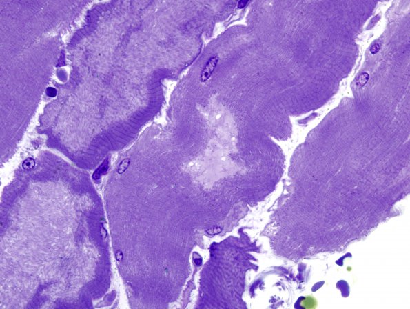 1D3 Myosin Loss Myopathy, patchy (Case 1) Plastic 6