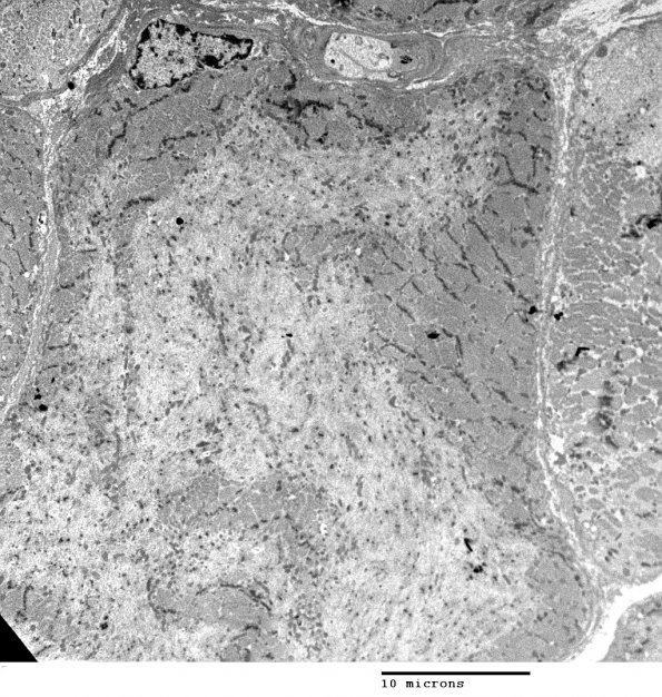 1E1 Myosin Loss Myopathy, patchy (Case 1) 003 - Copy