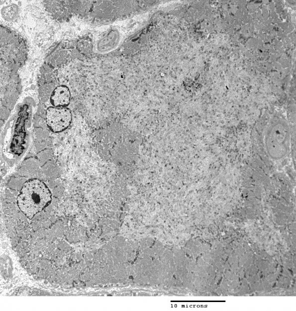 1E2 Myosin Loss Myopathy, patchy (Case 1) 011 - Copy - Copy