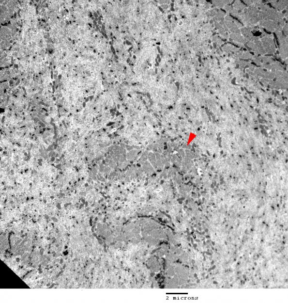 1E3 Myosin Loss Myopathy, patchy (Case 1) 005 copy - Copy