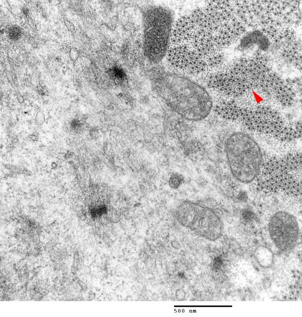 1E4 Myosin Loss Myopathy, patchy (Case 1) 016 copy - Copy