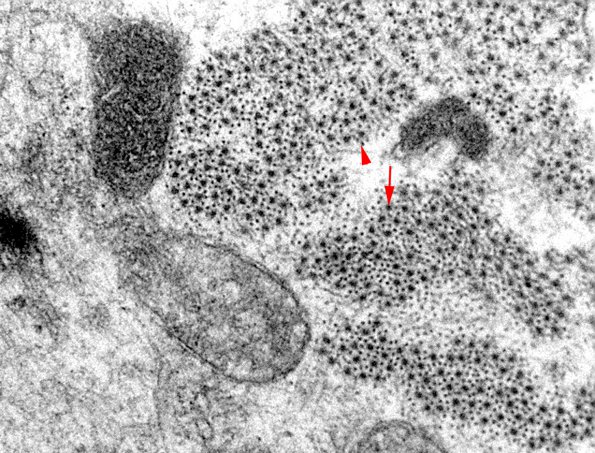 1E4A Myosin Loss Myopathy, patchy (Case 1) 016 copy - Copy