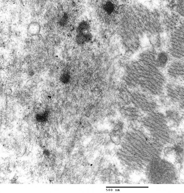 1E5 Myosin Loss Myopathy, patchy (Case 1) 021 - Copy