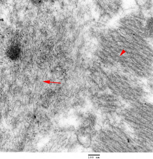 1E6 Myosin Loss Myopathy, patchy (Case 1) 022 copy - Copy