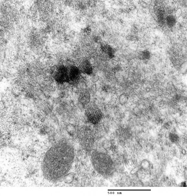 1E7 Myosin Loss Myopathy, patchy (Case 1) 027 - Copy