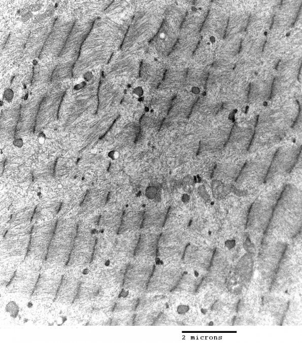 1F1 Myosin Loss Myopathy, patchy (Case 1) 032 - Copy