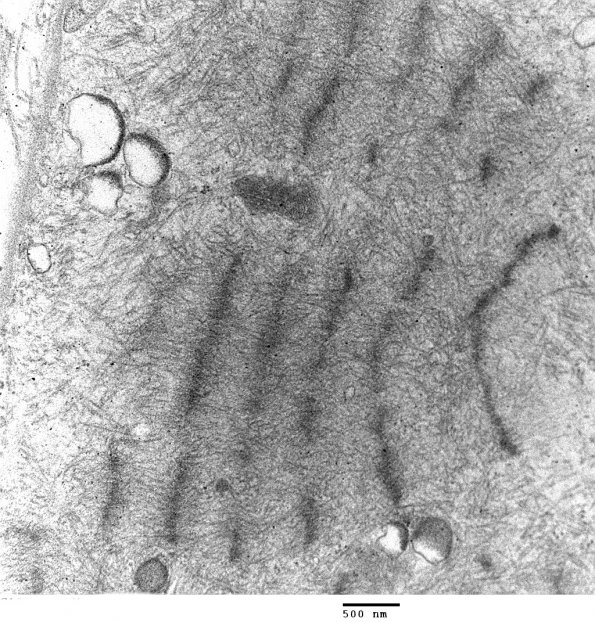 1F2 Myosin Loss Myopathy, patchy (Case 1) 037 - Copy