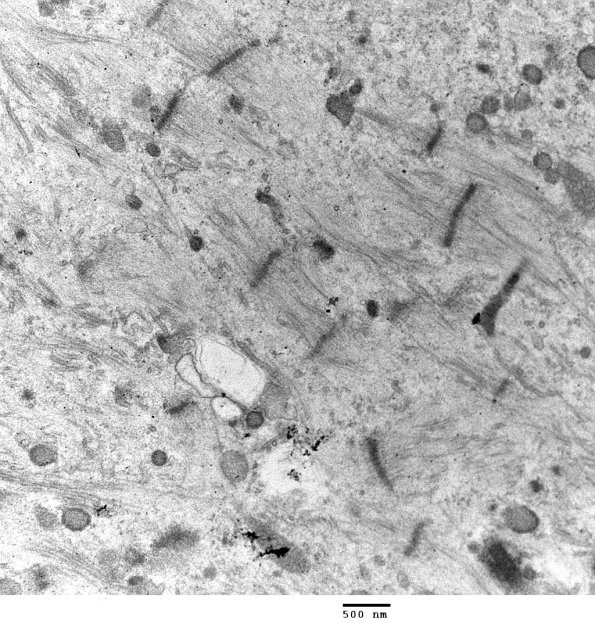 1F3 Myosin Loss Myopathy, patchy (Case 1) 049 - Copy