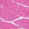 2A Myosin loss myopathy (Case 2) H&E