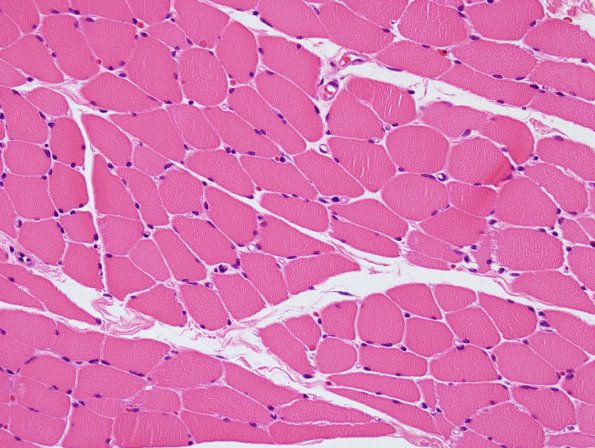 2A Myosin loss myopathy (Case 2) H&E