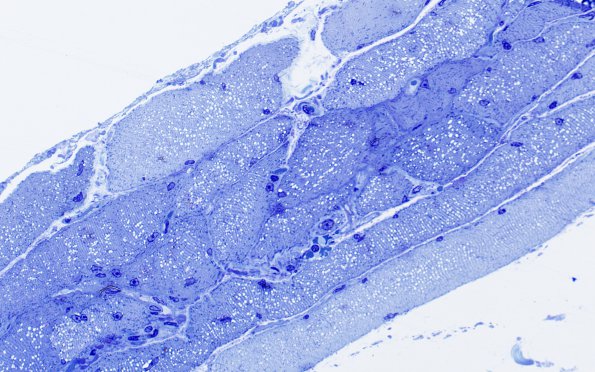 2B1 Myosin loss myopathy (Case 2) Plastic 40XA