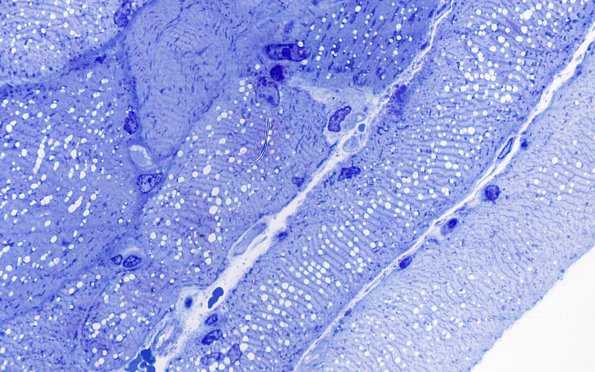 2B2 Myosin loss myopathy (Case 2) Plastic 100XA