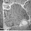 2C1 Myosin loss Myopathy (Critical Illness Myopathy, Case 2) EM 017 - Copy