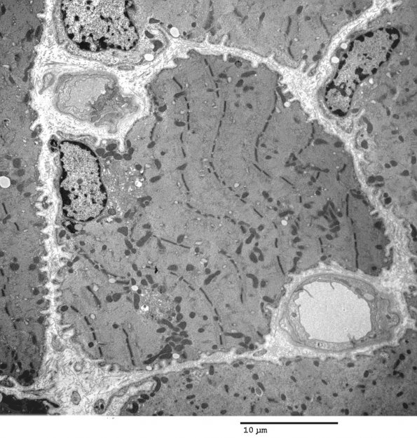 2C1 Myosin loss Myopathy (Critical Illness Myopathy, Case 2) EM 017 - Copy