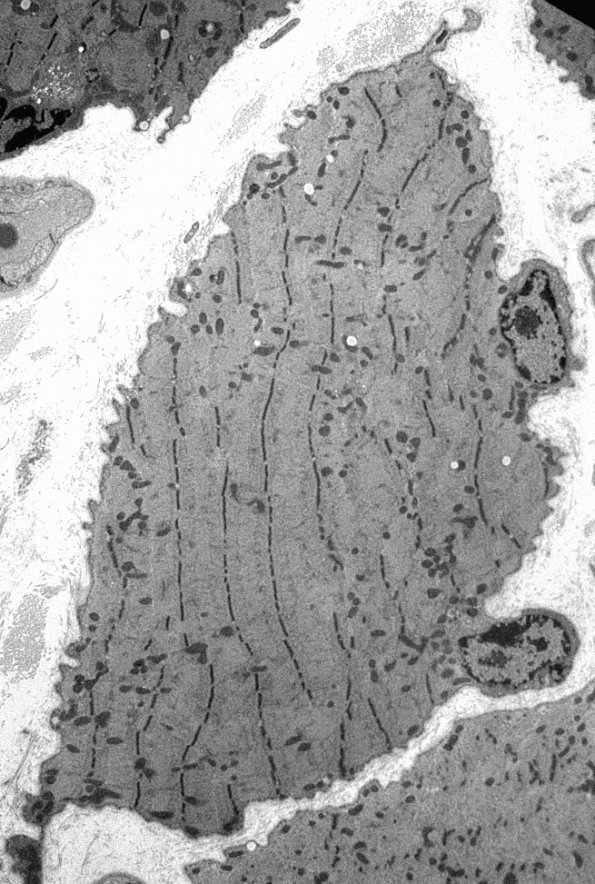 2C2 Myosin loss Myopathy (Critical Illness Myopathy, Case 2) EM 019 - Copy