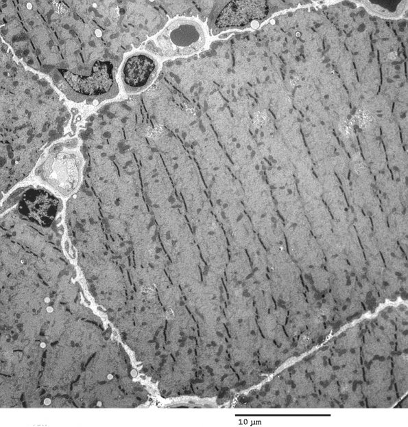 2C3 Myosin loss Myopathy (Critical Illness Myopathy, Case 2) EM 014 - Copy