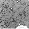 2C4 Myosin loss Myopathy (Critical Illness Myopathy, Case 2) EM 006 - Copy