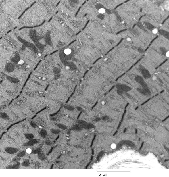 2C4 Myosin loss Myopathy (Critical Illness Myopathy, Case 2) EM 006 - Copy