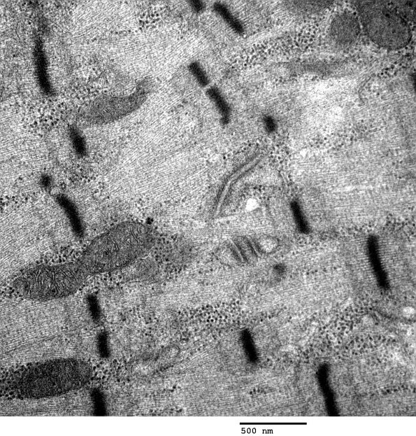 2C6 Myosin loss Myopathy (Critical Illness Myopathy, Case 2) EM 035 - Copy