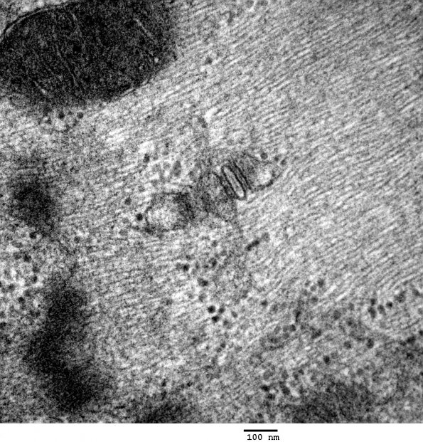 2C8 Myosin loss Myopathy (Critical Illness Myopathy, Case 2) EM 028 - Copy