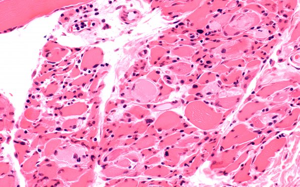 3A2 Myosin loss myopathy (Case 3) H&E 6