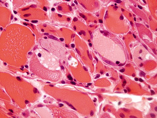 3A3 Myosin loss myopathy (Case 3) H&E 2