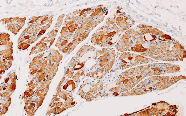 3B1 Myosin loss myopathy (Case 3) desmin 3