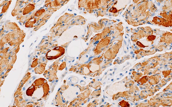 3B2 Myosin loss myopathy (Case 3) desmin 6