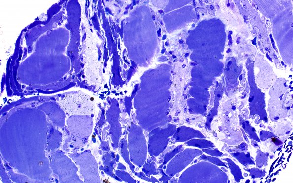 3C Myosin loss myopathy (Case 3) Plastic 4