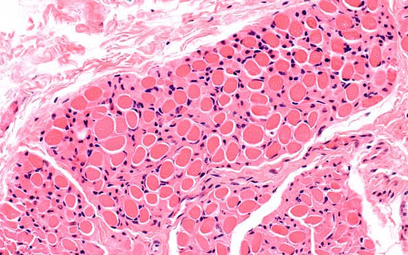 4A Myosin loss myopathy & mitochondriopathy (Case 4) H&E 1