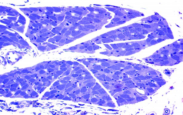 4B1 Myosin loss myopathy & mitochondriopathy (Case 4) 40X