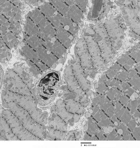 4C1 Myosin loss myopathy & mitochondriopathy (S09-26925) EM 001 - Copy