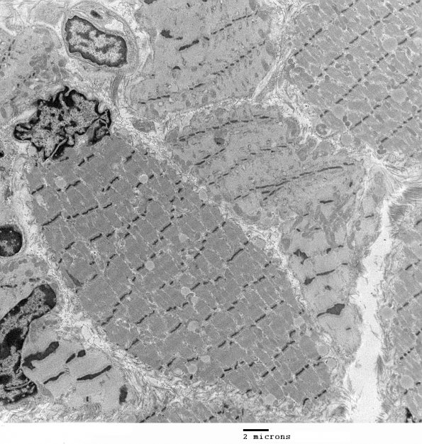 4C2 Myosin loss myopathy & mitochondriopathy (S09-26925) EM 011 - Copy (2)