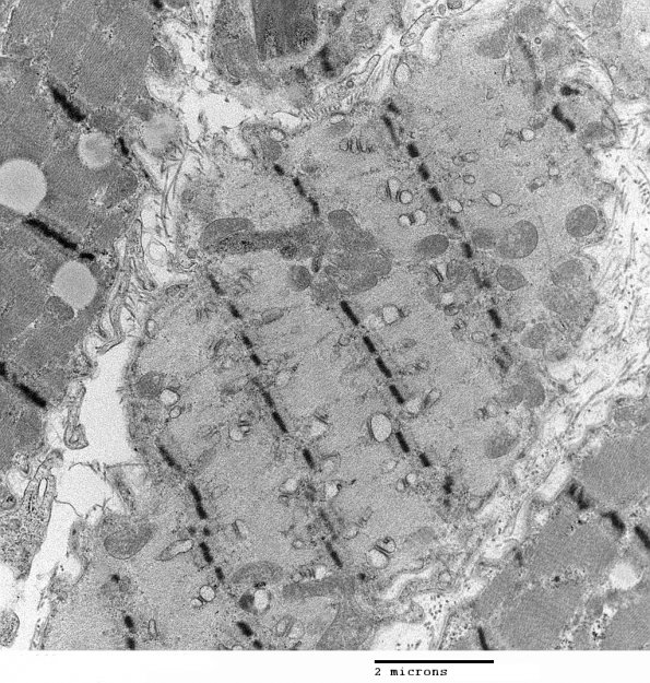 4C4 Myosin loss myopathy & mitochondriopathy (S09-26925) EM 002 - Copy