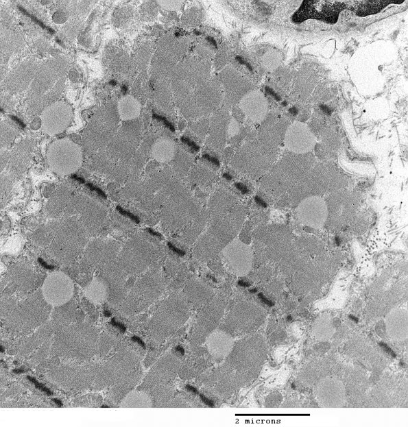 4C5 Myosin loss myopathy & mitochondriopathy (S09-26925) EM 006 - Copy