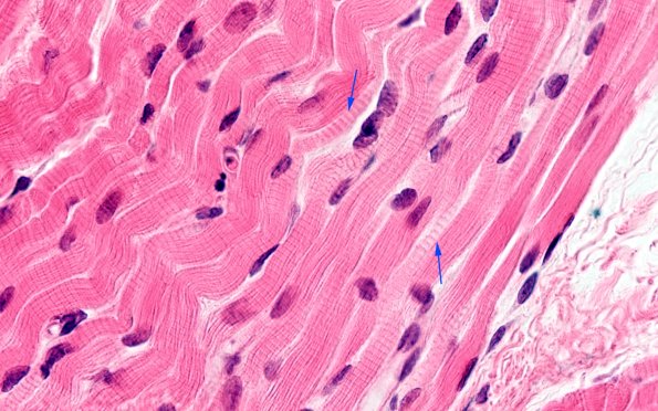 8A2B (Case 8) H&E 100X 9 copy