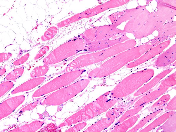 1A1-Muscle-myotendinous-junction-Case-1-H-E-2.jpg