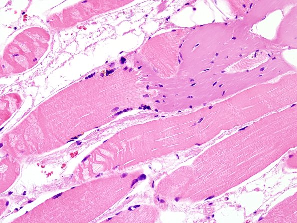 1A2-Muscle-myotendinous-junction-Case-1-H-E-3.jpg