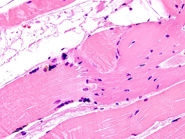 1A3-Muscle-myotendinous-junction-Case-1-H-E-4.jpg