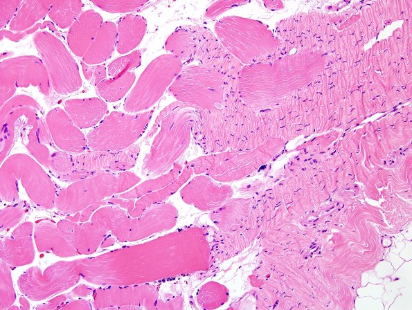 1A4-Muscle-myotendinous-junction-Case-1-H-E-6.jpg
