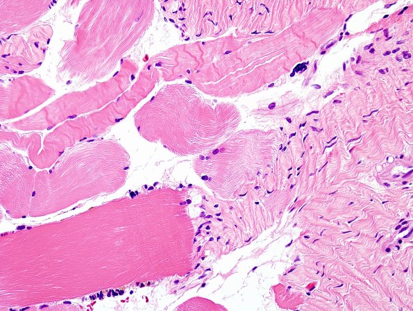 1A5-Muscle-myotendinous-junction-Case-1-H-E-1.jpg