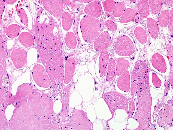 1A6-Muscle-myotendinous-junction-Case-1-H-E-5.jpg