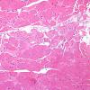 2A1-Muscle-tendon-insertion-zone-Case-2-H-E-3.jpg