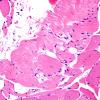 2A3-Muscle-tendon-insertion-zone-Case-2-H-E-1.jpg