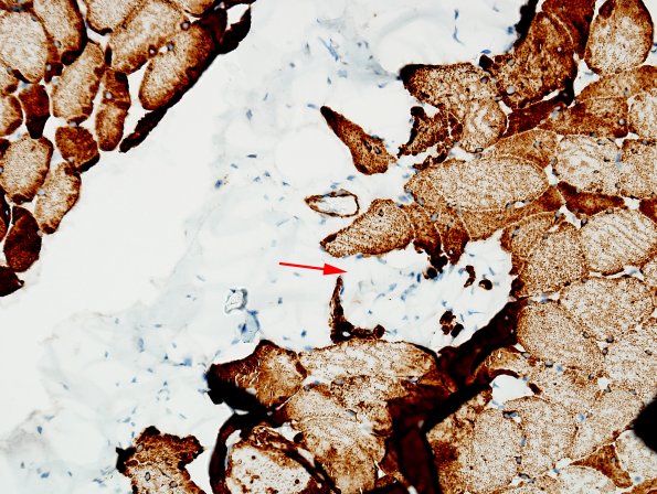 2B-Muscle-tendon-insertion-zone-Case-2-desmin-copy.jpg