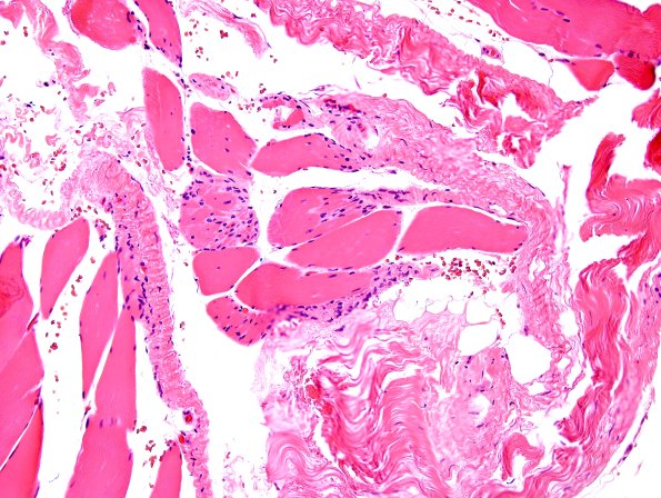 3A1 Myotendinous Junction (Case 3) H&E 5