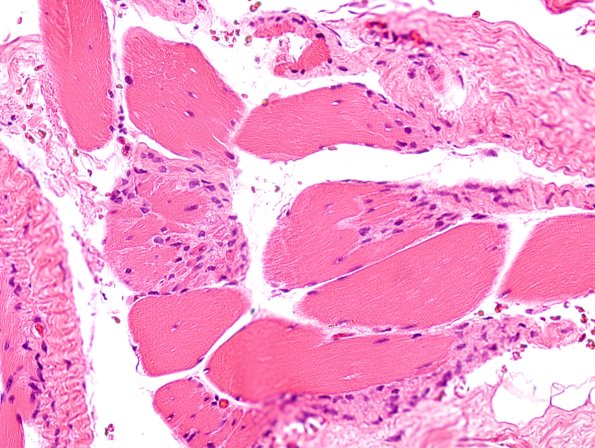 3A2 Myotendinous Junction (Case 3) H&E 1