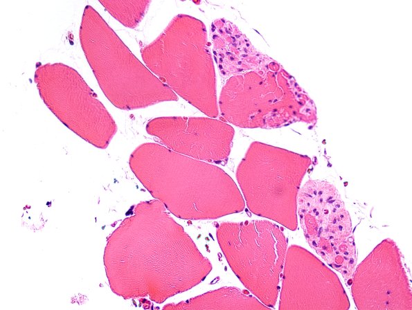 3A3 Myotendinous Junction (Case 3) H&E 3