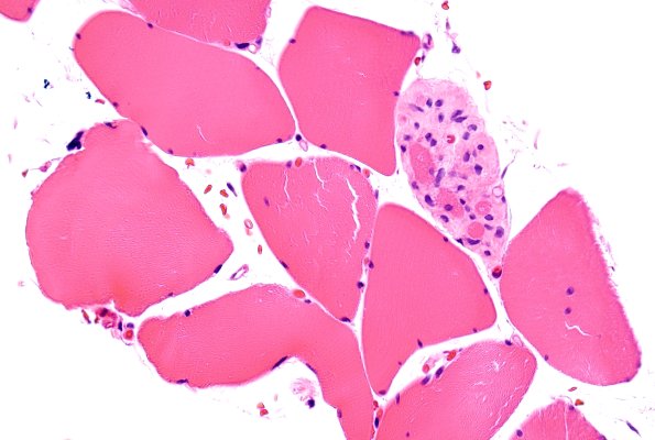 3A4 Myotendinous Junction (Case 3) H&E 2